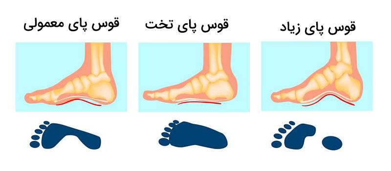 کفش مناسب فرم پا