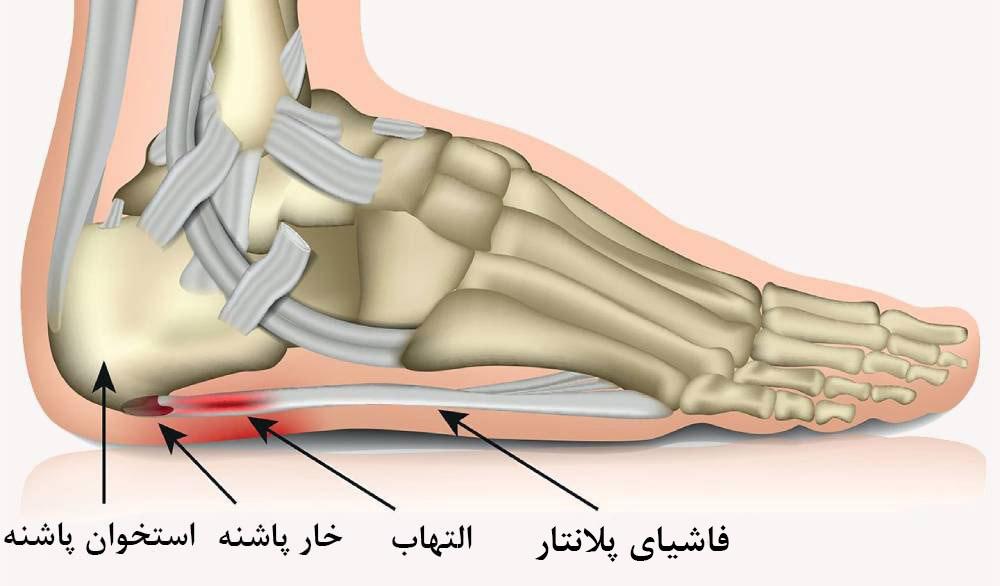 خار پاشنه چیست؟
